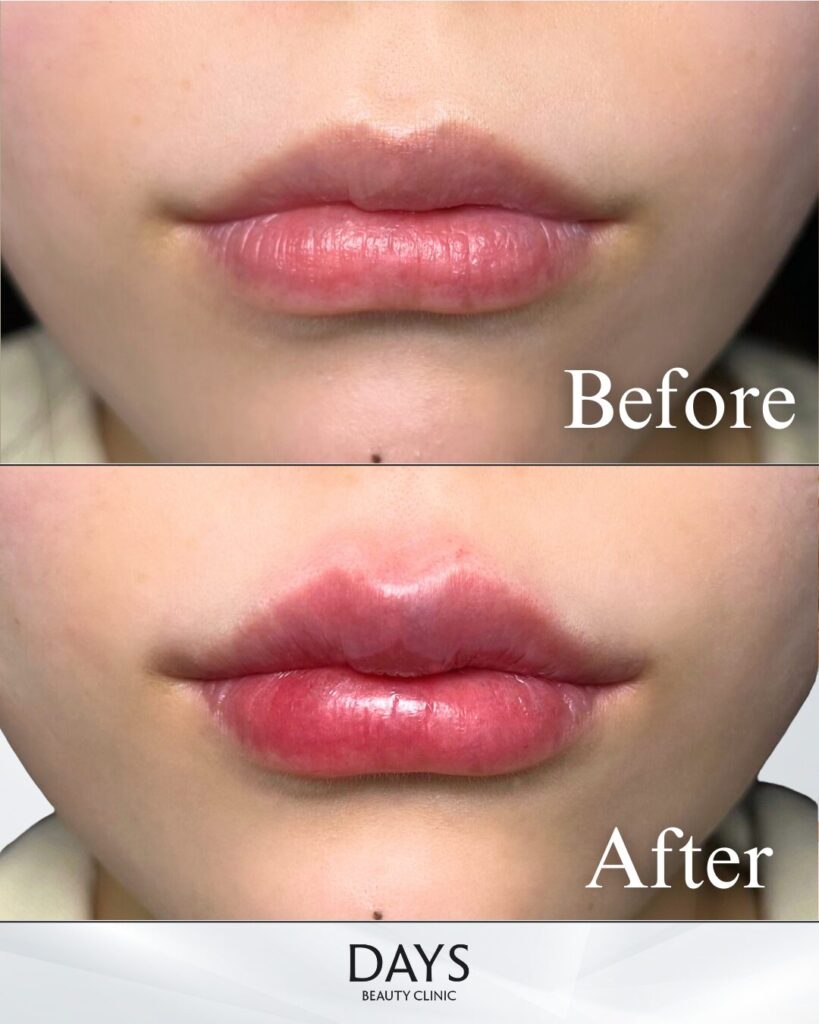 唇ヒアルロン酸　症例　20代女性